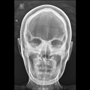 X-Ray/Radiographic Positioning Doll