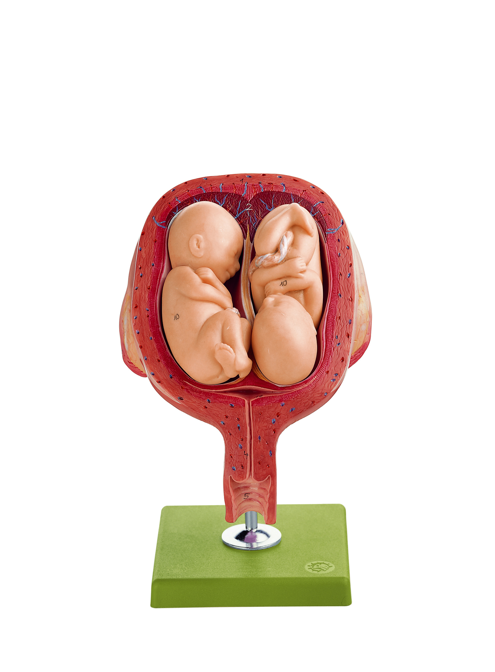 Uterus With Twin Fetus in Fifth Month