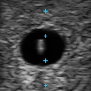 Vascular Access Ultrasound Phantom - 4 Vein Bifurcated With Deep Vein, Dark