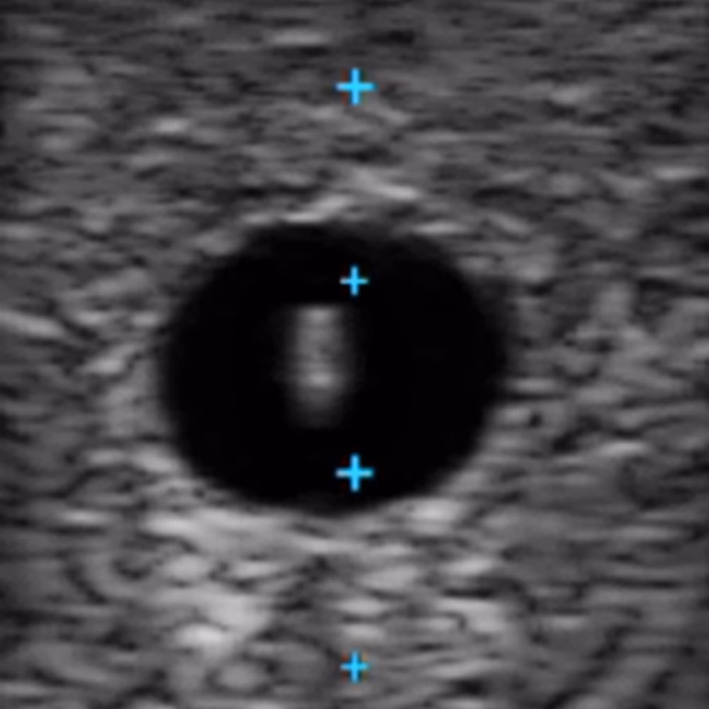 Vascular Access Ultrasound Phantom - 4 Vein Bifurcated With Deep Vein, Dark