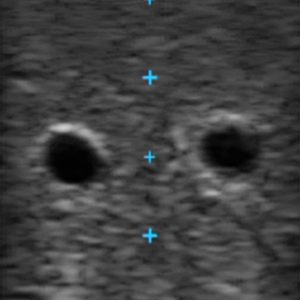Vascular Access Ultrasound Phantom - 4 Vein Bifurcated With Deep Vein, Dark