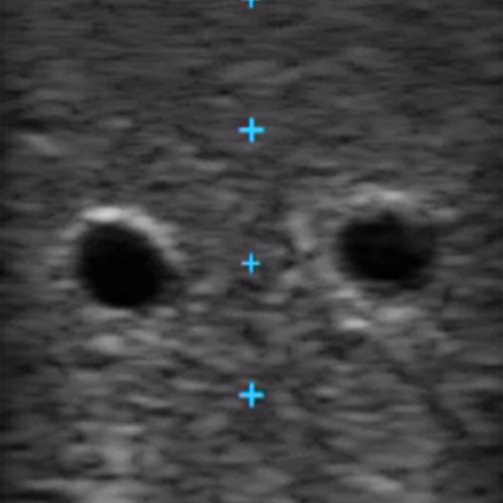 Vascular Access Ultrasound Phantom - 4 Vein Bifurcated With Deep Vein, Dark