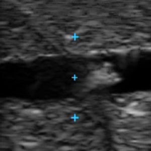 Vascular Access Ultrasound Phantom - 4 Vein Bifurcated With Deep Vein, Dark