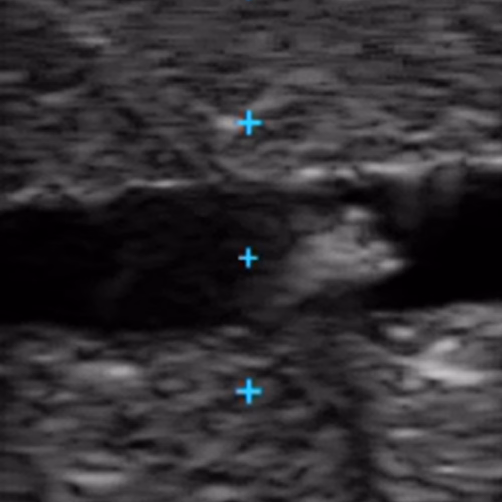Vascular Access Ultrasound Phantom - 4 Vein Bifurcated With Deep Vein, Dark