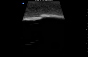 Ultrasound Phantom - Bone Fracture, Light