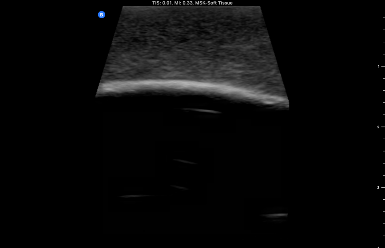 Ultrasound Phantom - Bone Fracture, Light