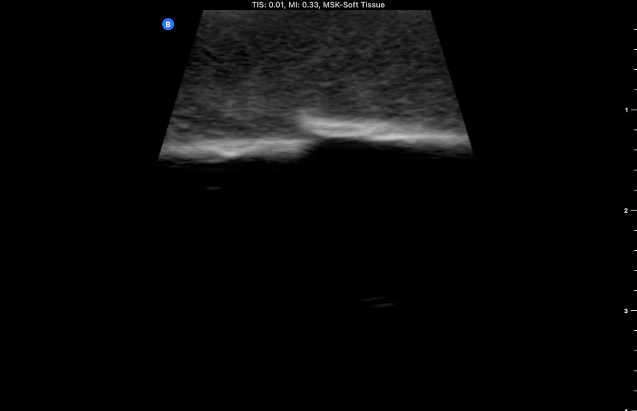 Ultrasound Phantom, Bone Fracture, Dark