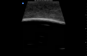 Ultrasound Phantom, Bone Fracture, Dark