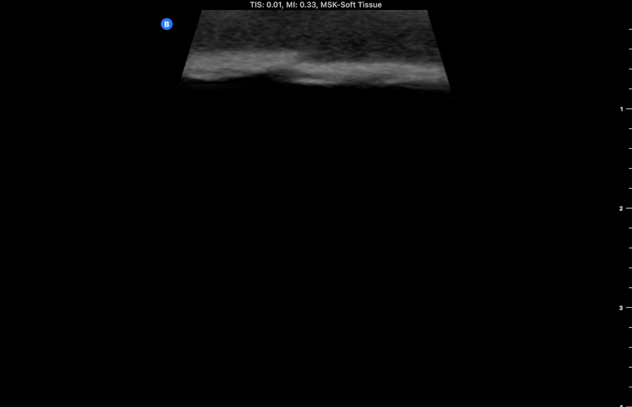 Ultrasound Phantom, Bone Fracture, Dark
