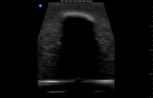 Ultrasound Phantom, Bone Fracture, Dark