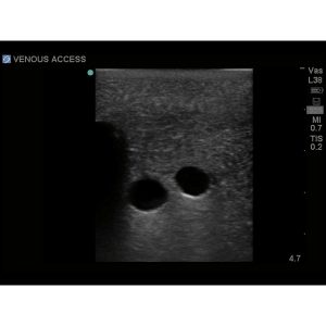 Tissue Insert For Gen I Central Venous Access, With Hand Pump
