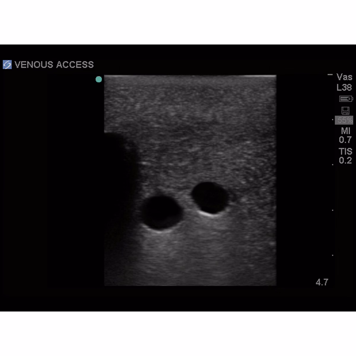 Tissue Insert For Gen I Central Venous Access, With Hand Pump