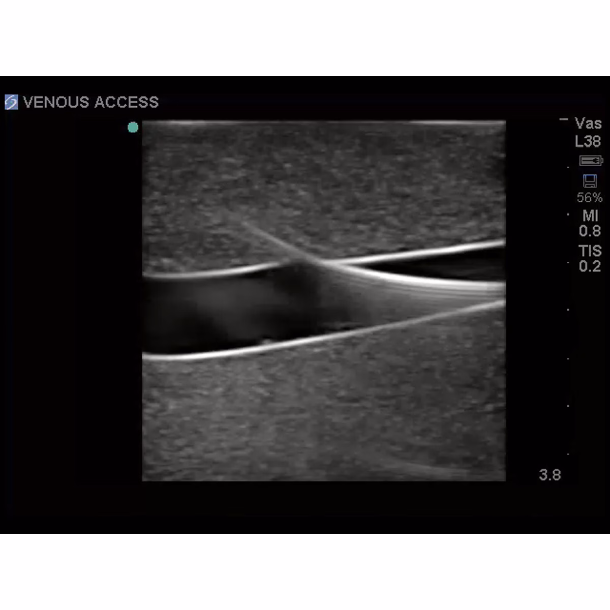 Tissue Insert For Gen I Central Venous Access, With Hand Pump