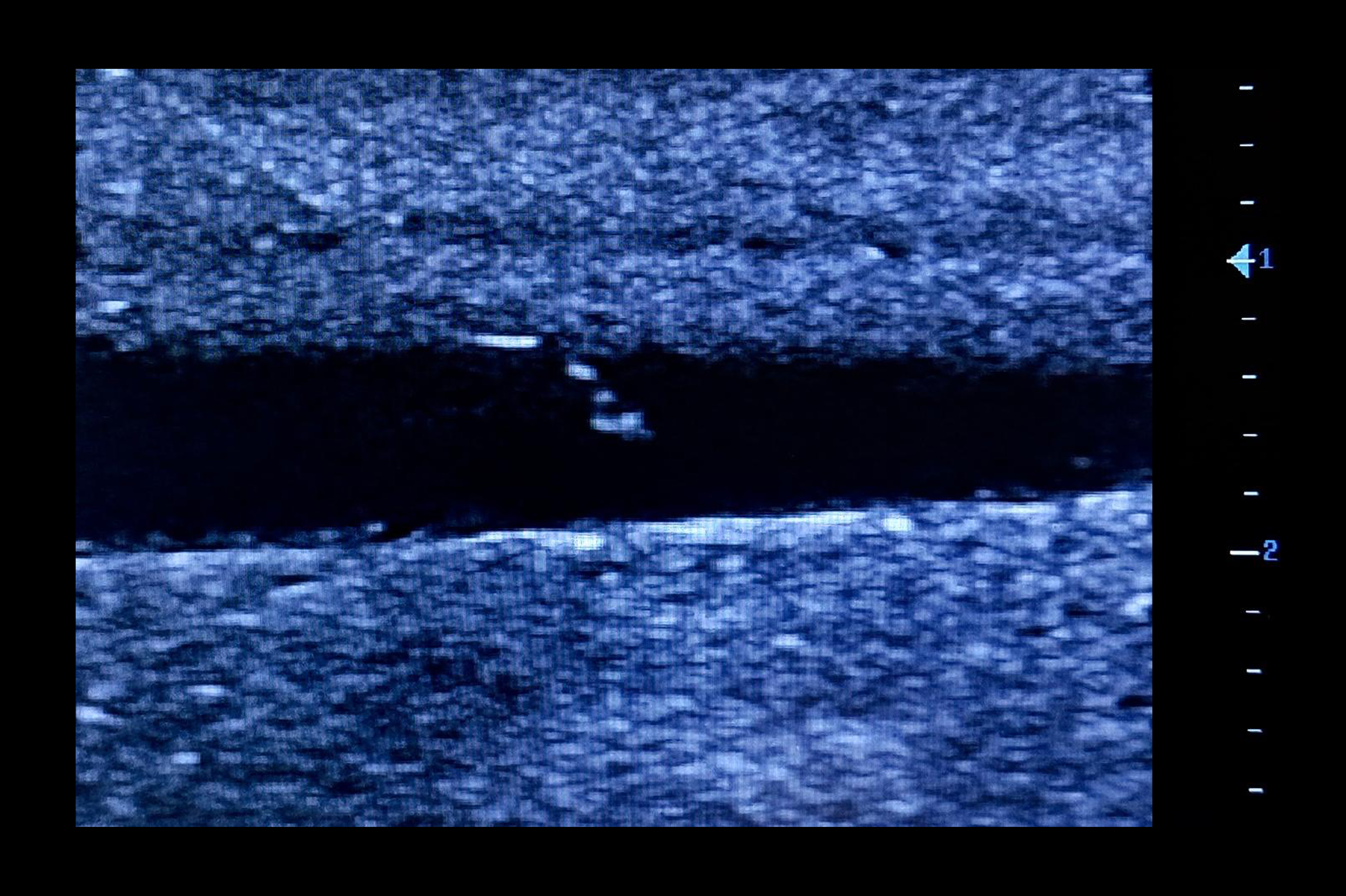 Ultrasound Simulator for Seldinger Technique, Dark