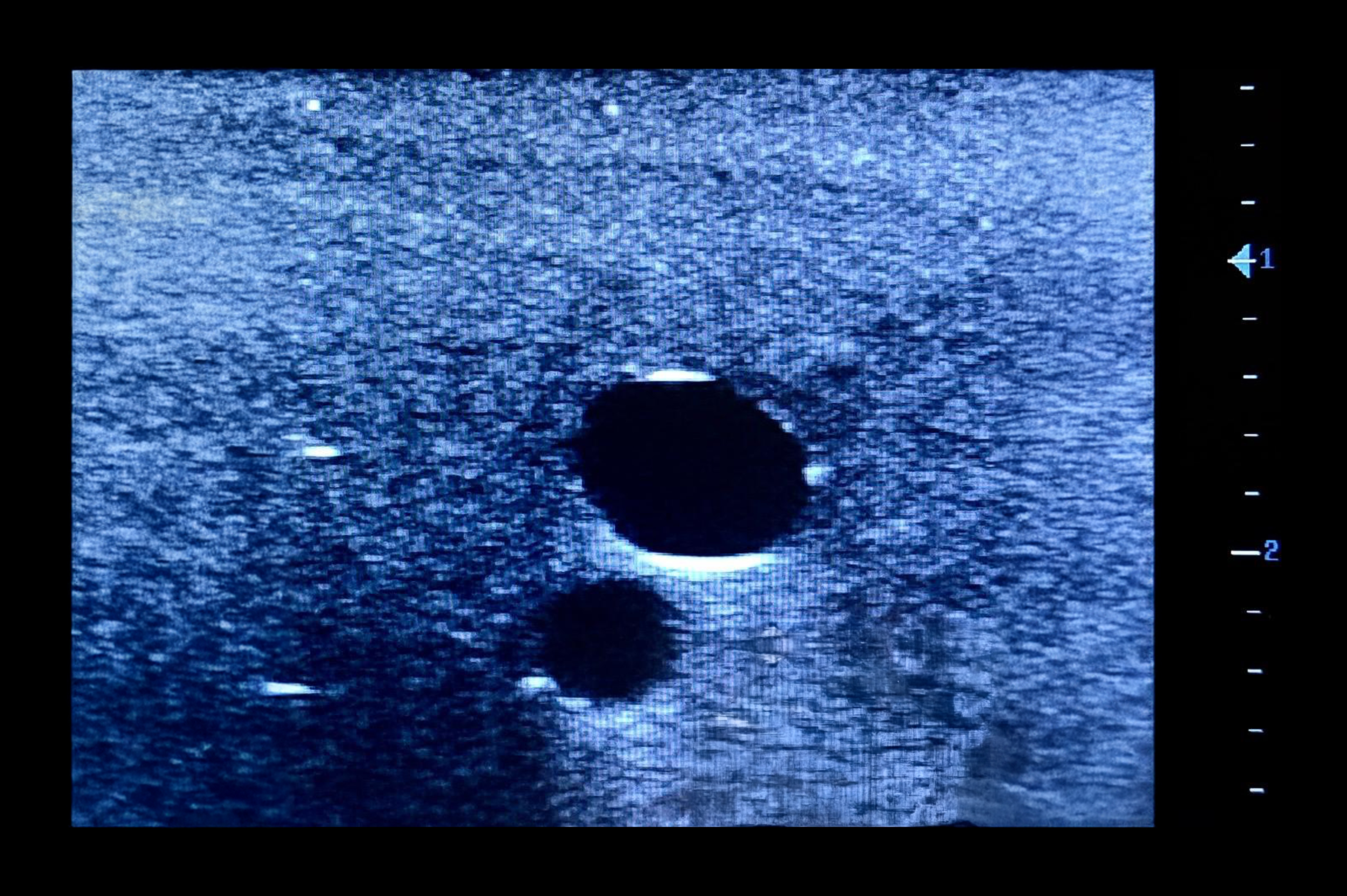 Ultrasound Simulator with 2 Femoral Access Routes, Light