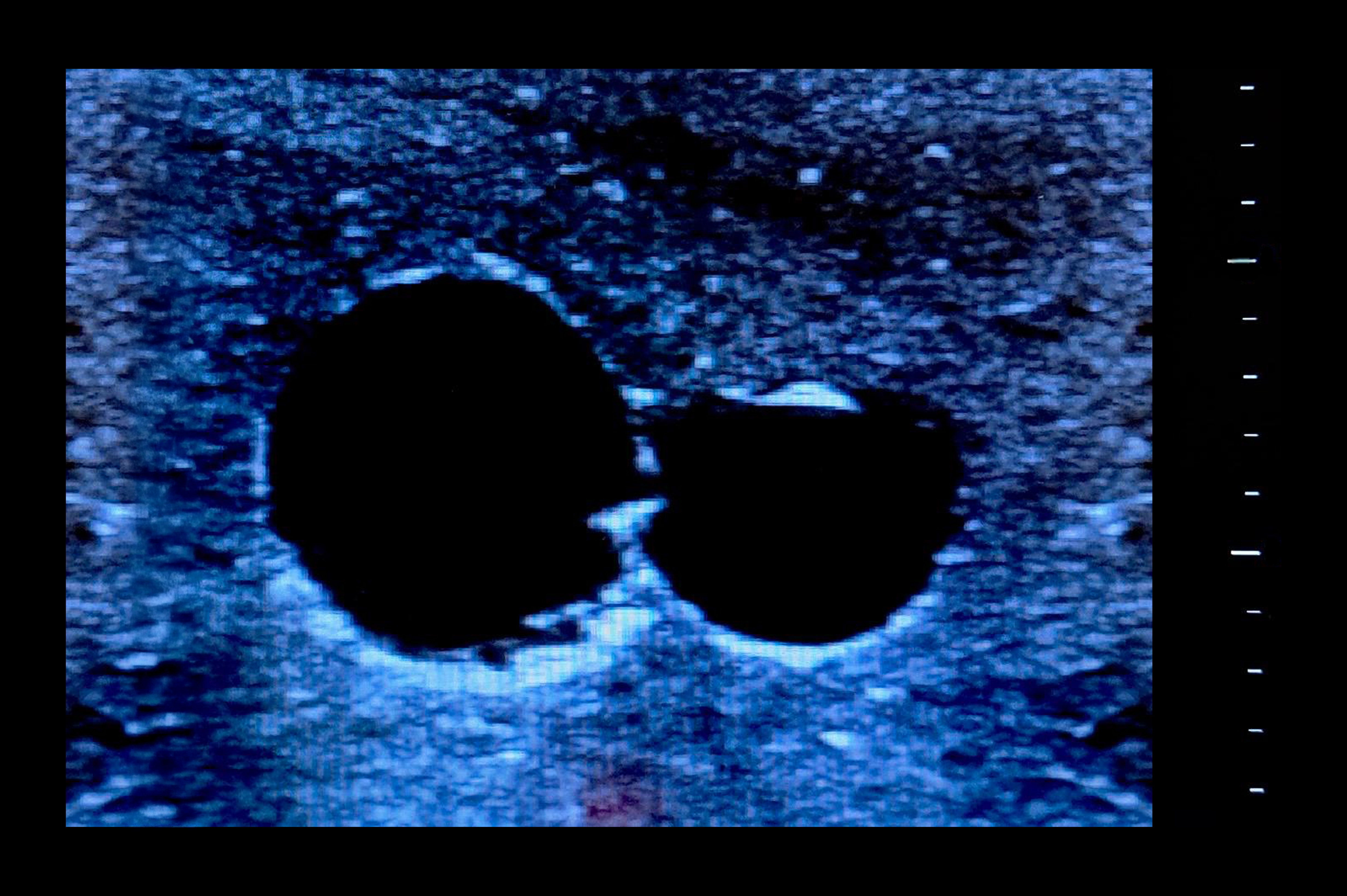 Central Access Ultrasound Simulator with Aneurysms, Dark