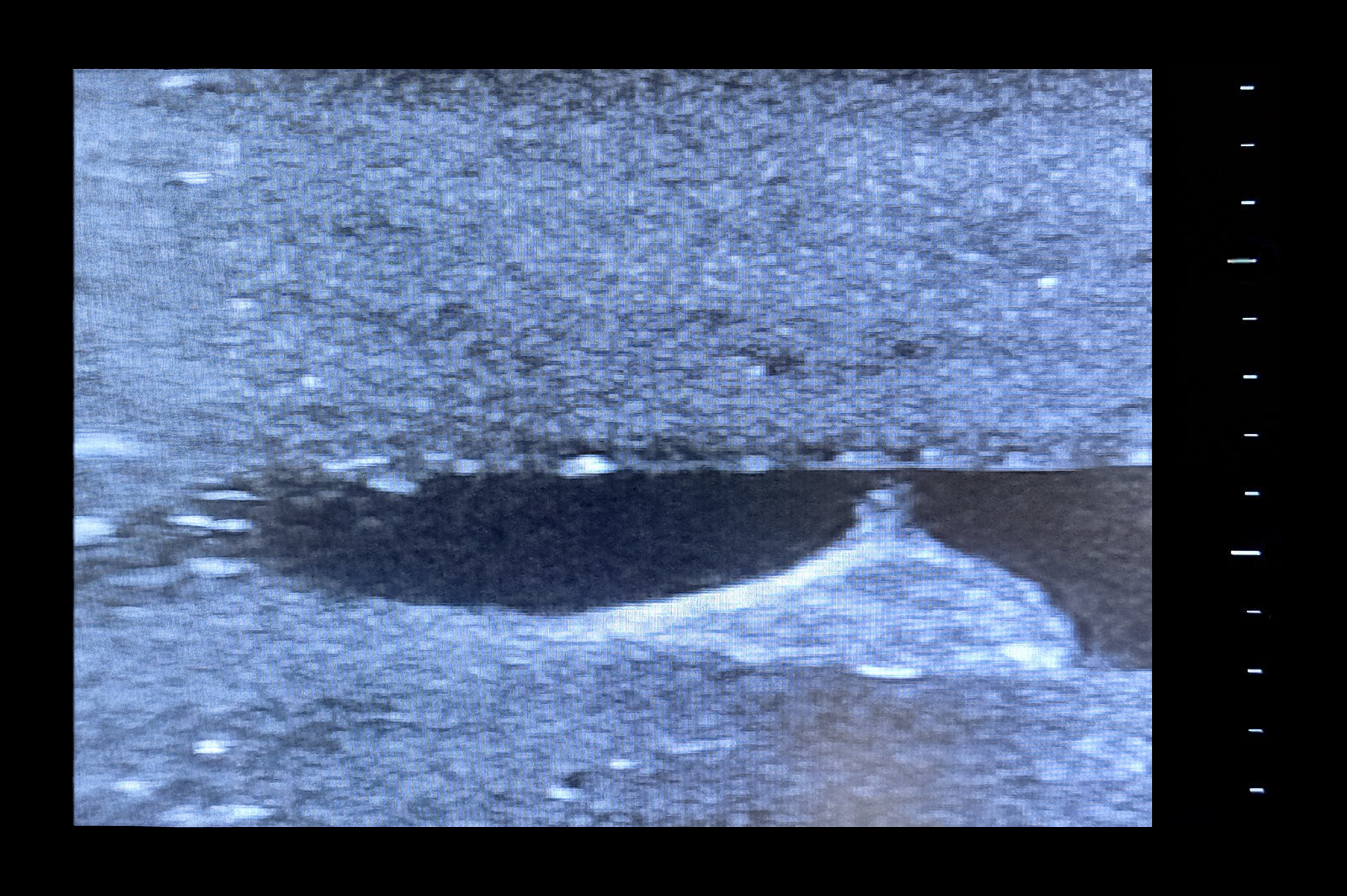 Central Access Ultrasound Simulator with Calcifications, Light