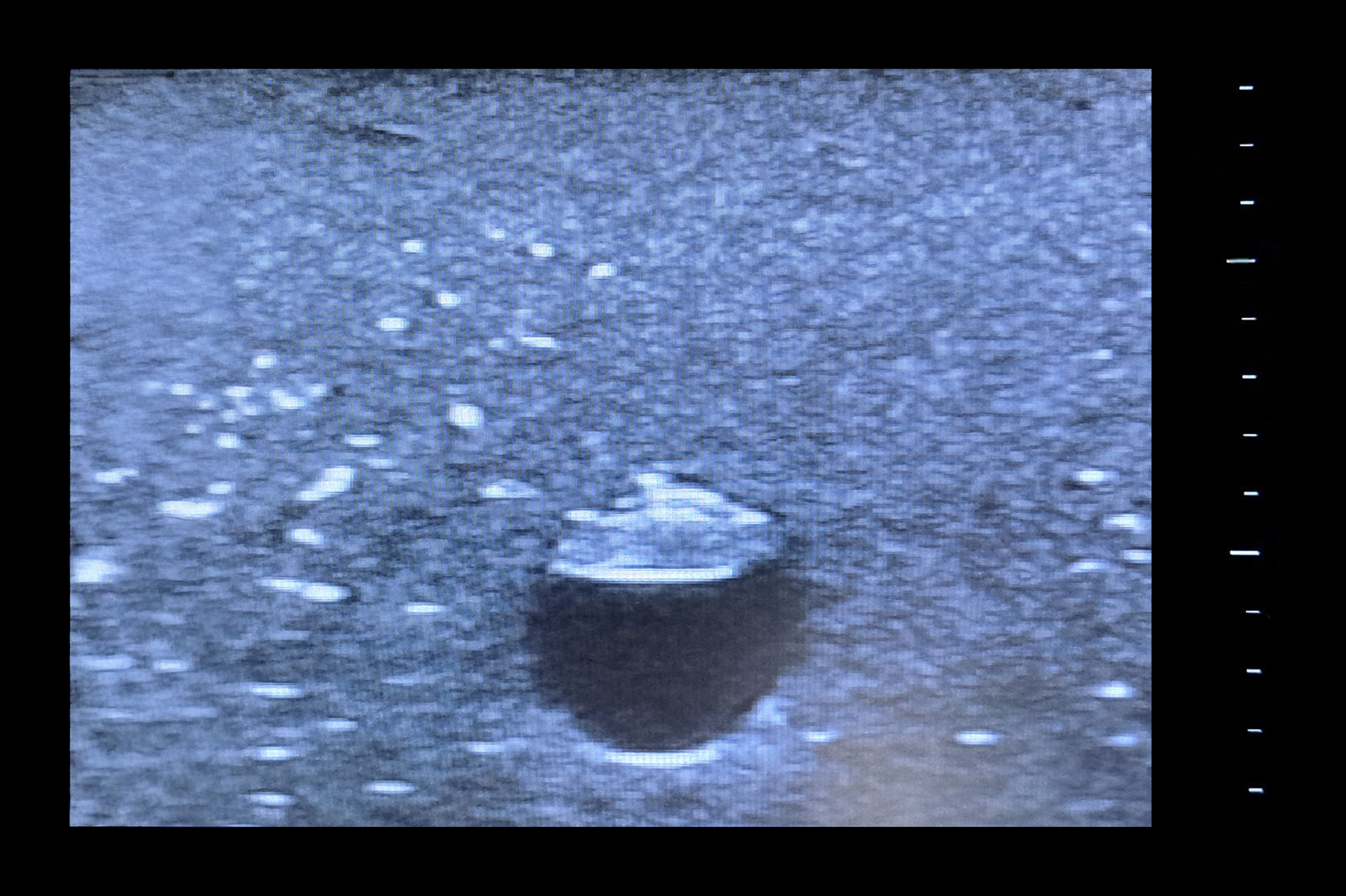 Central Access Ultrasound Simulator with Calcifications, Dark