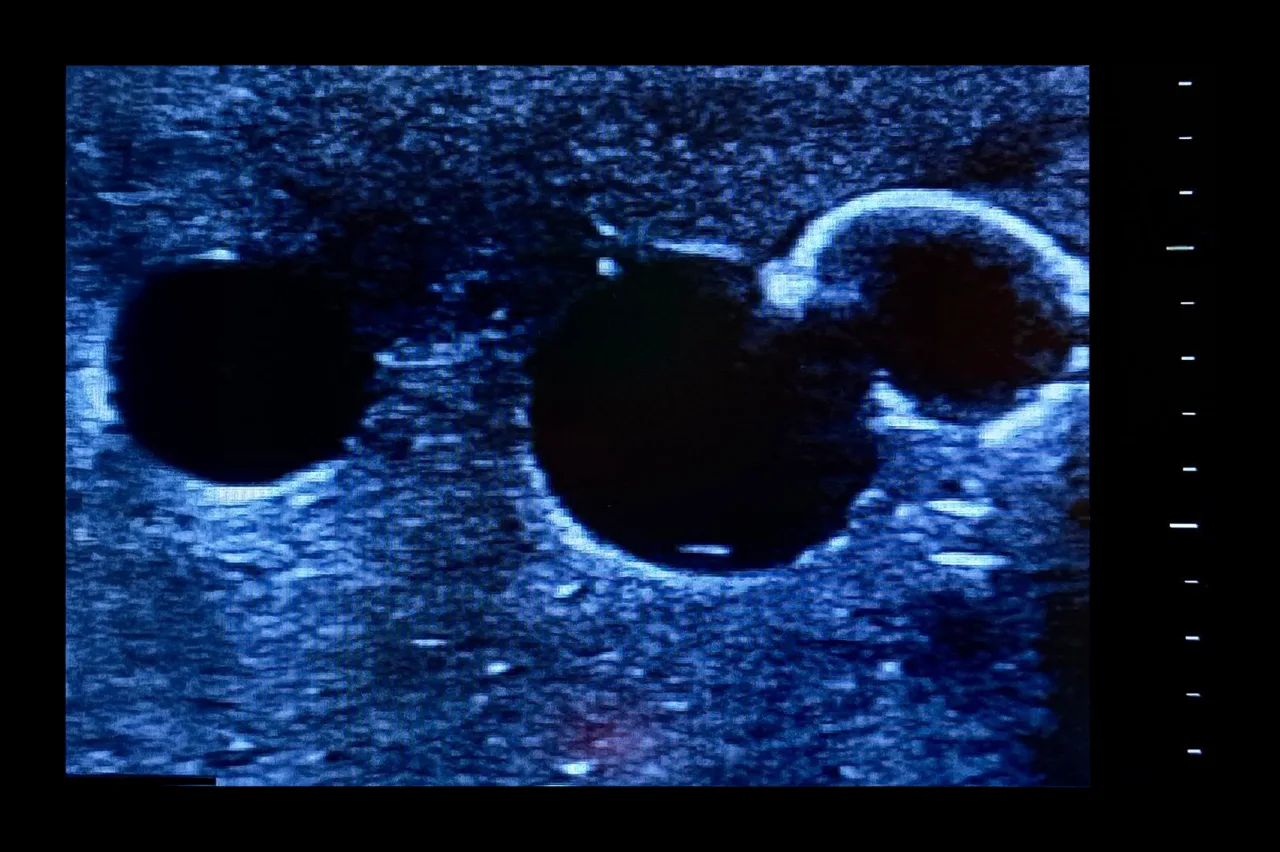 Femoral Access Ultrasound Simulator with Calcifications, Light