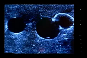 Femoral Access Ultrasound Simulator with Calcifications, Light
