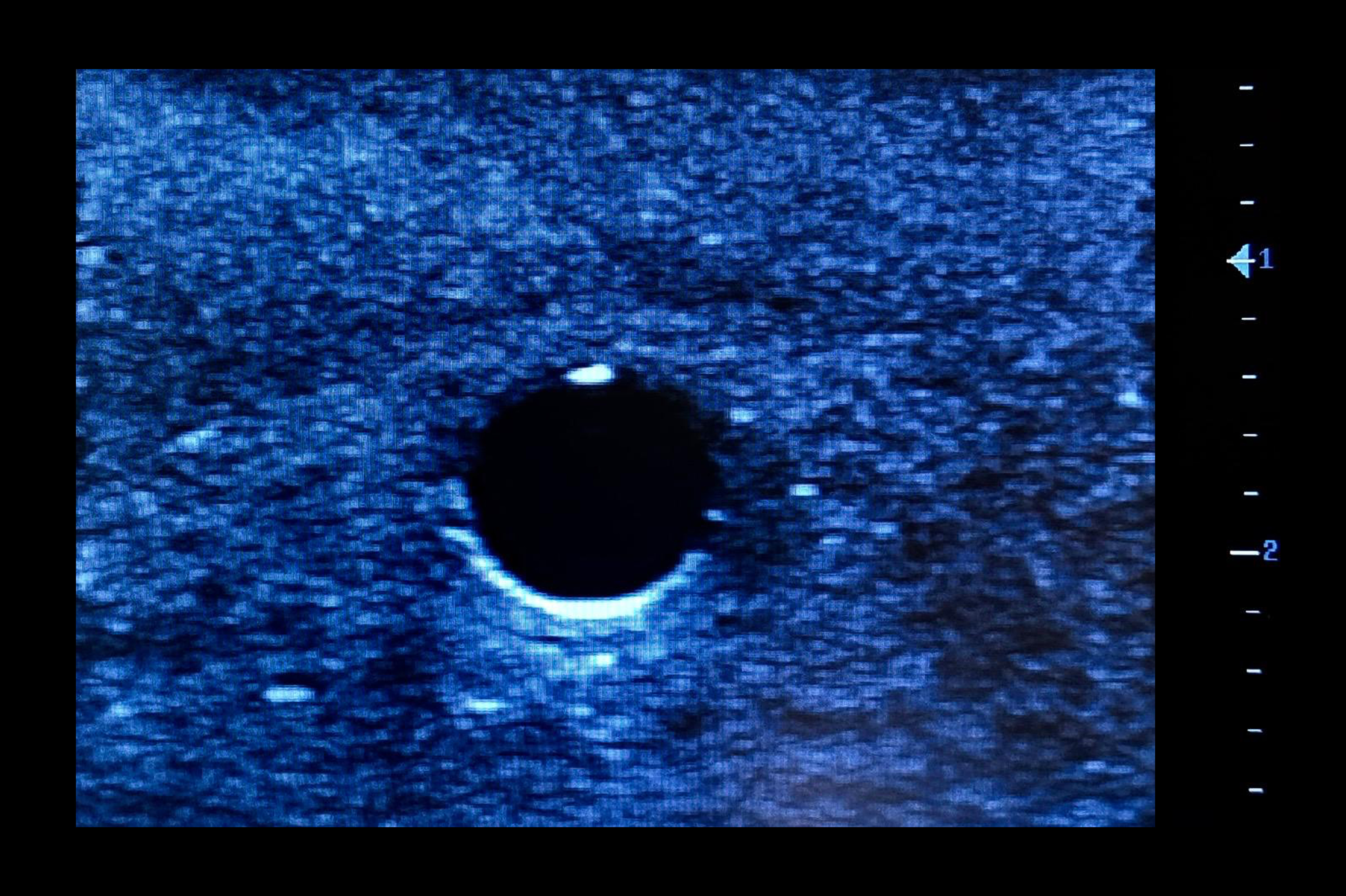 Femoral Access Ultrasound Simulator with Aneurysms, Light