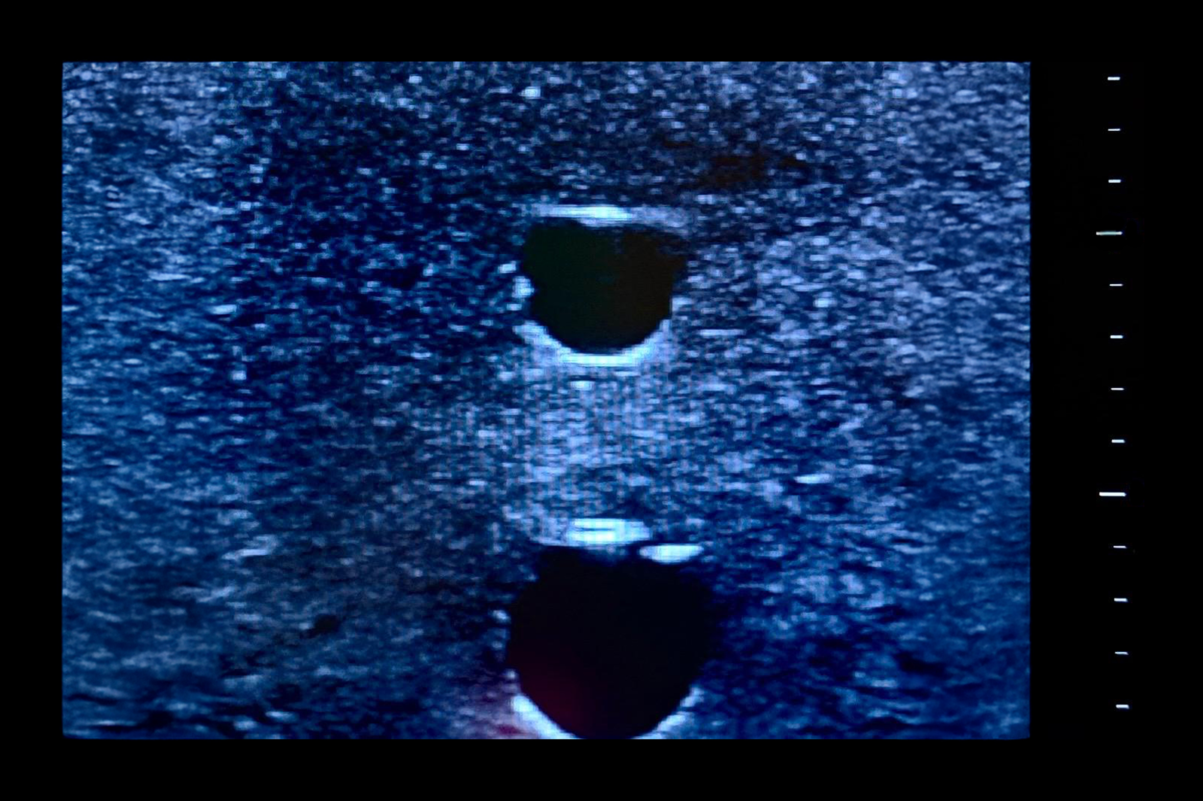 Ultrasound Simulator with 4 Central Lines, Dark