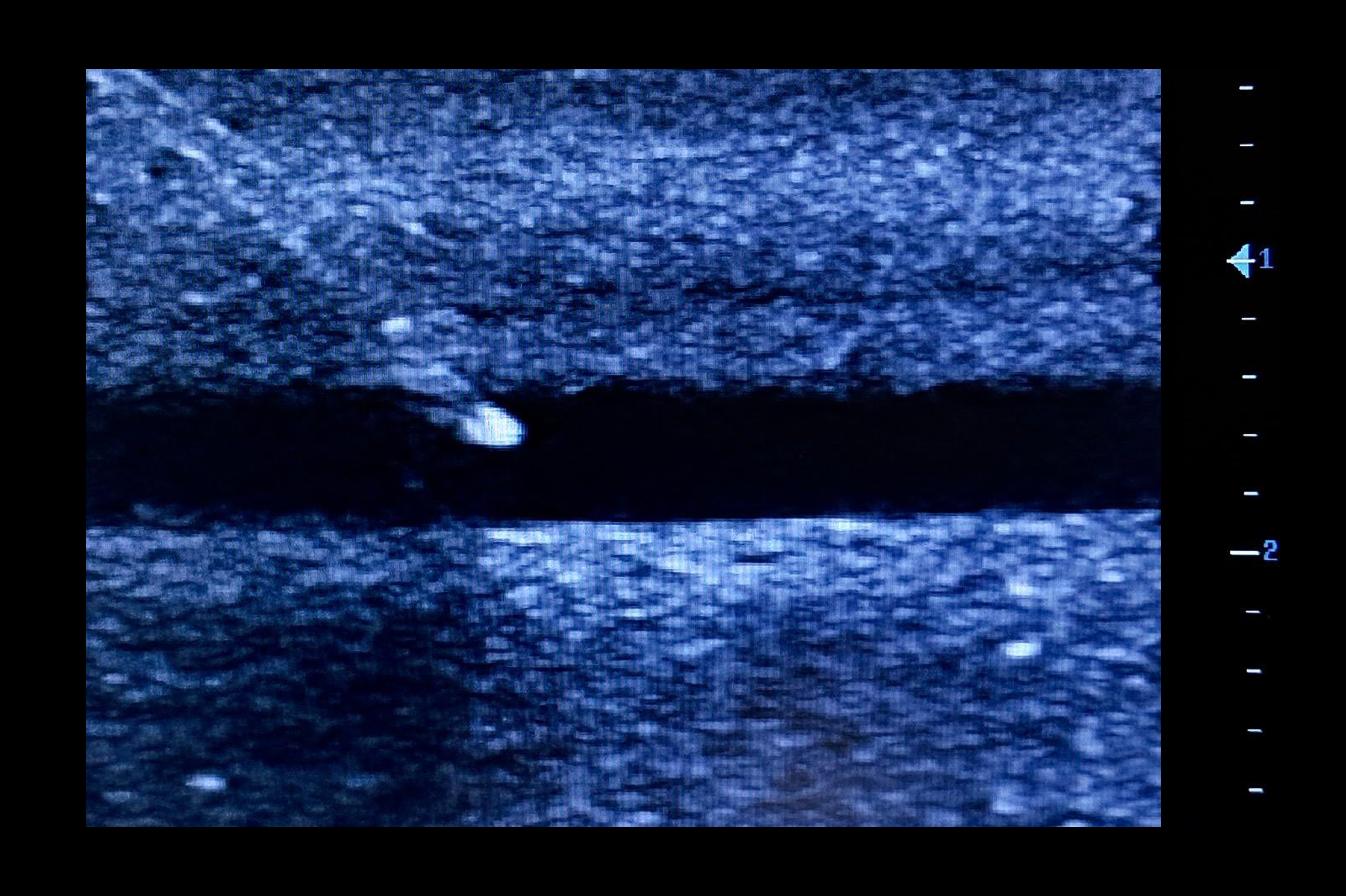 Ultrasound Simulator for Radial Artery Catheterisation, Dark