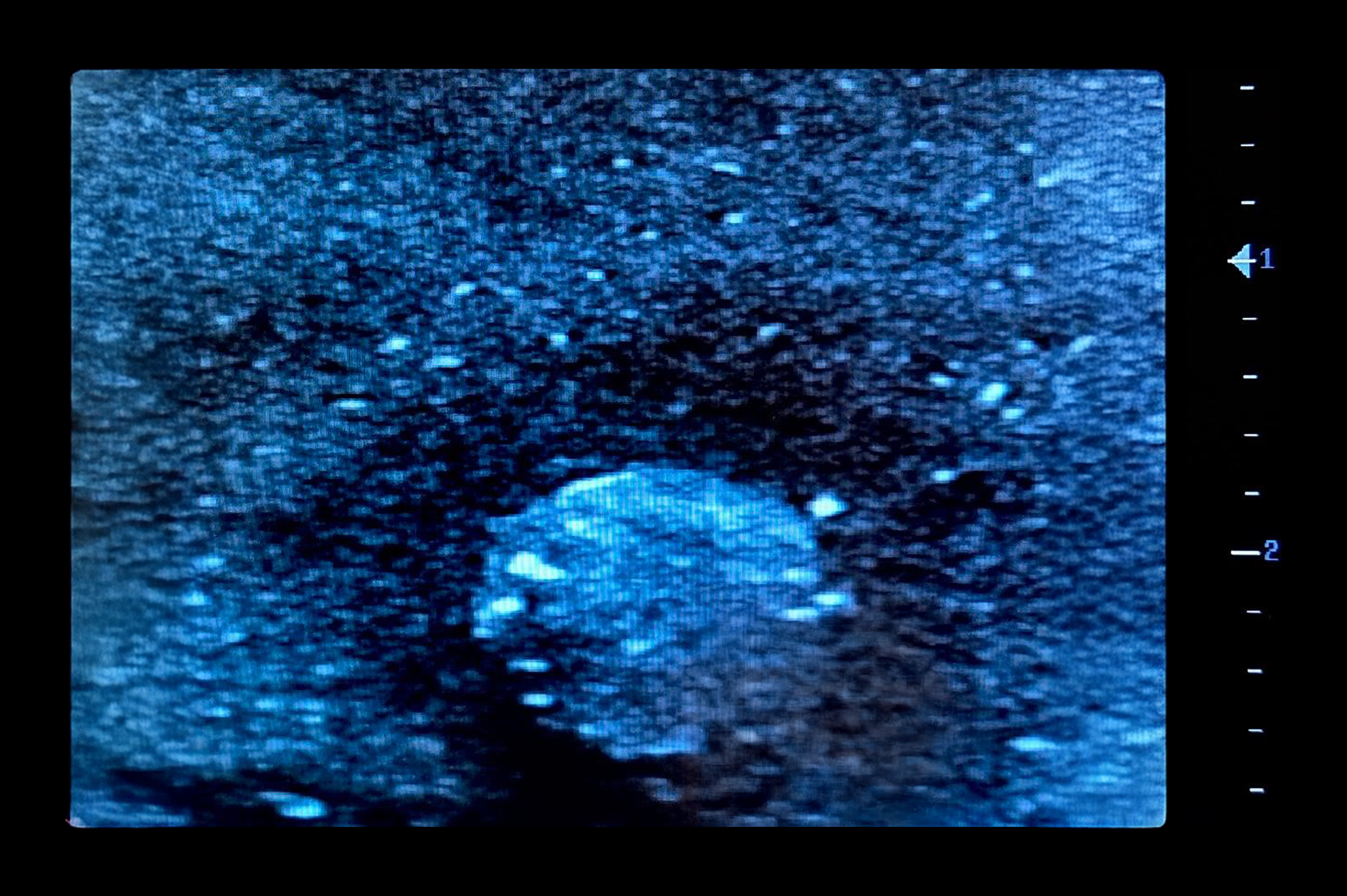 Ultrasound Simulator with Breast Pathologies/Biopsy, Light