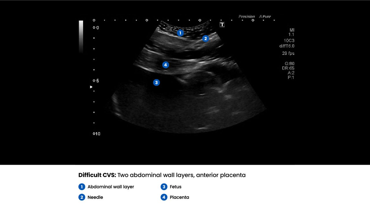 Amnio Abby® - Ultrasound Guided Invasive Procedures Simulator