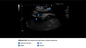Amnio Abby® - Ultrasound Guided Invasive Procedures Simulator