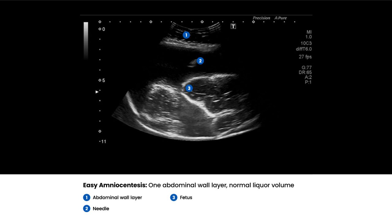 Amnio Abby® - Ultrasound Guided Invasive Procedures Simulator