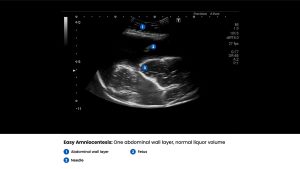 Amnio Abby® - Ultrasound Guided Invasive Procedures Simulator