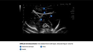 Amnio Abby® - Ultrasound Guided Invasive Procedures Simulator