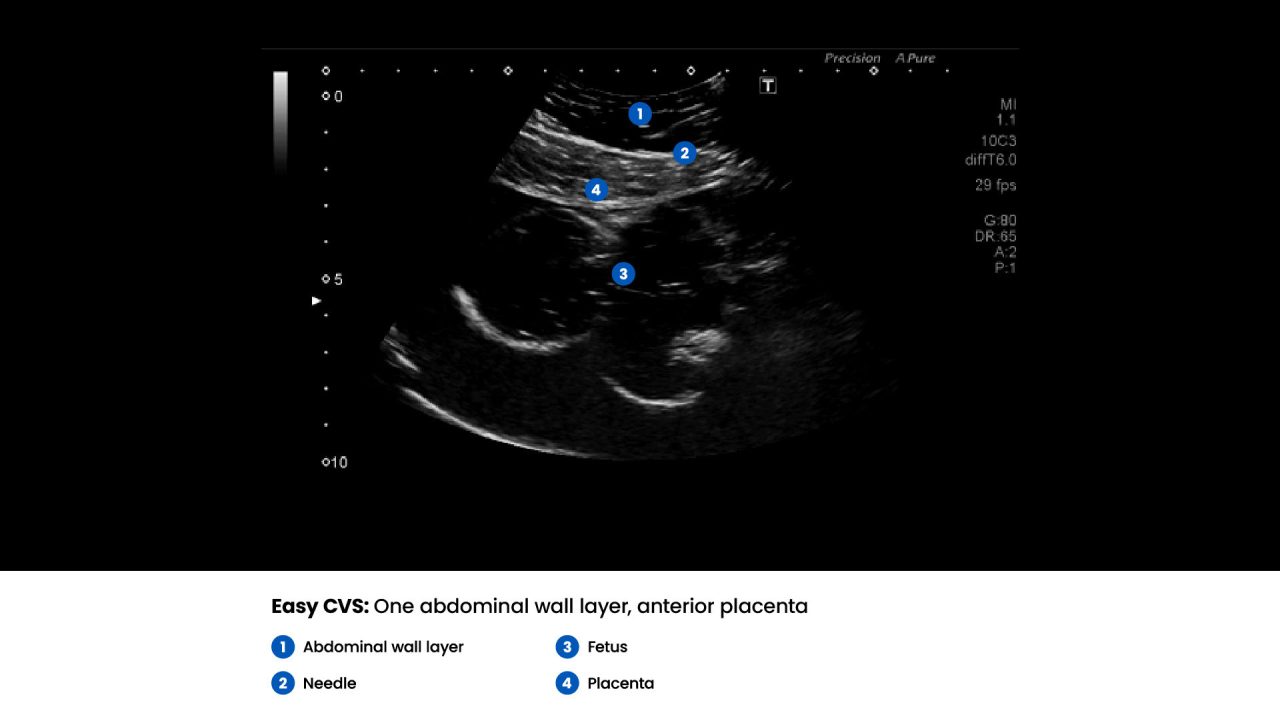 Amnio Abby® - Ultrasound Guided Invasive Procedures Simulator