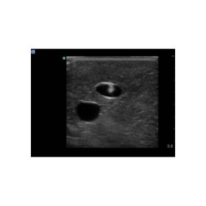 Gen II Central Line and Regional Anaesthesia Ultrasound Training Model With Hand Pump