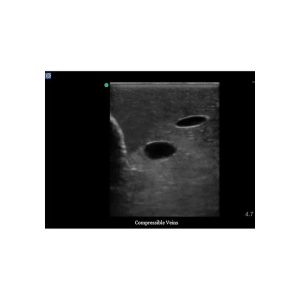 Gen II Central Line and Regional Anaesthesia Ultrasound Training Model With Hand Pump