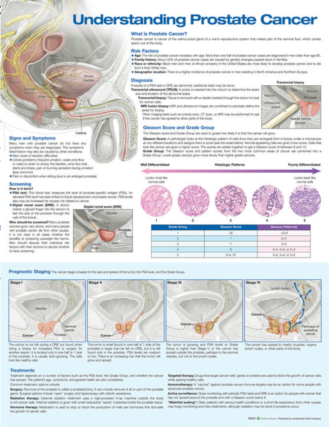 Understanding Prostate Cancer Chart