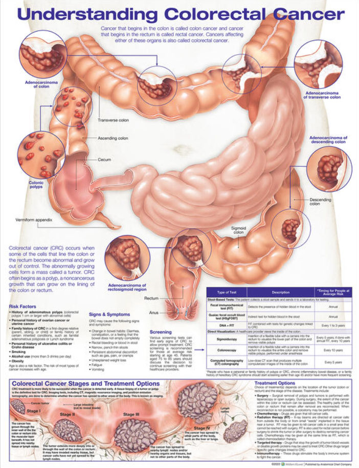 Understanding Colorectal Cancer Chart