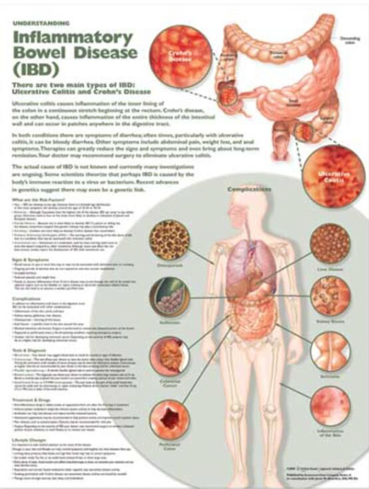 Understanding Inflammatory Bowel Disorder Chart