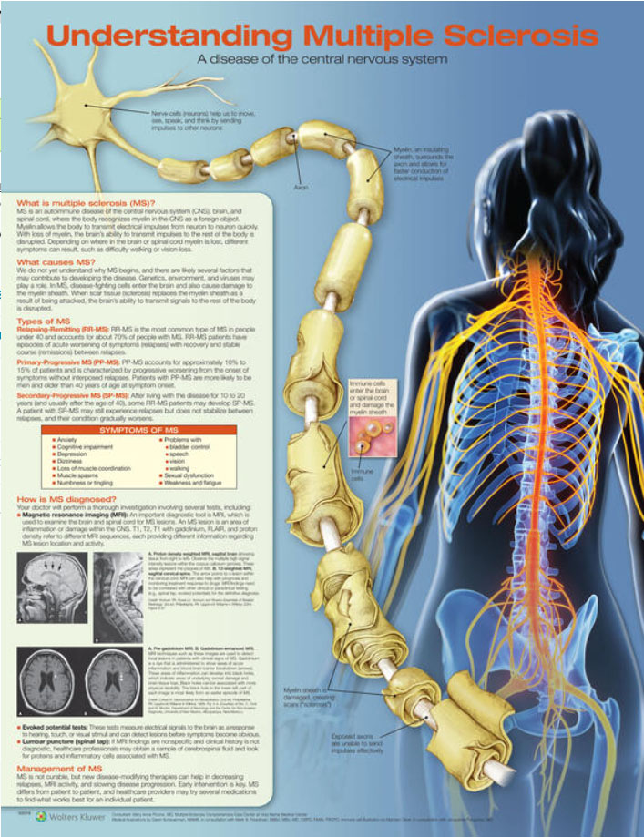 Understanding Multiple Sclerosis Chart