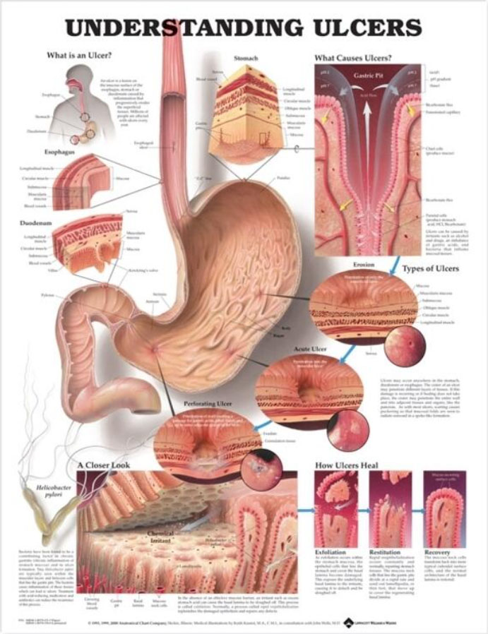 Understanding Ulcers Chart