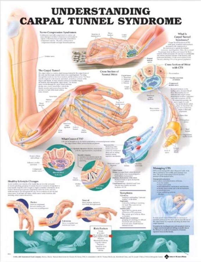 Understanding Carpal Tunnel Syndrome Chart