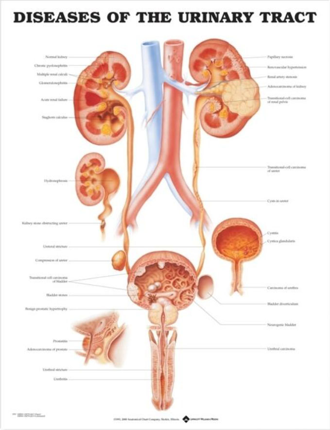 Diseases of the Urinary Tract Chart