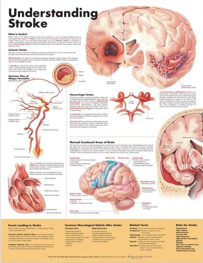 Understanding Stroke Chart