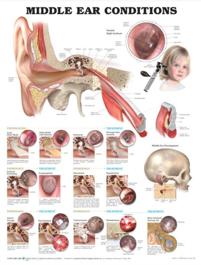 Middle Ear Conditions Chart
