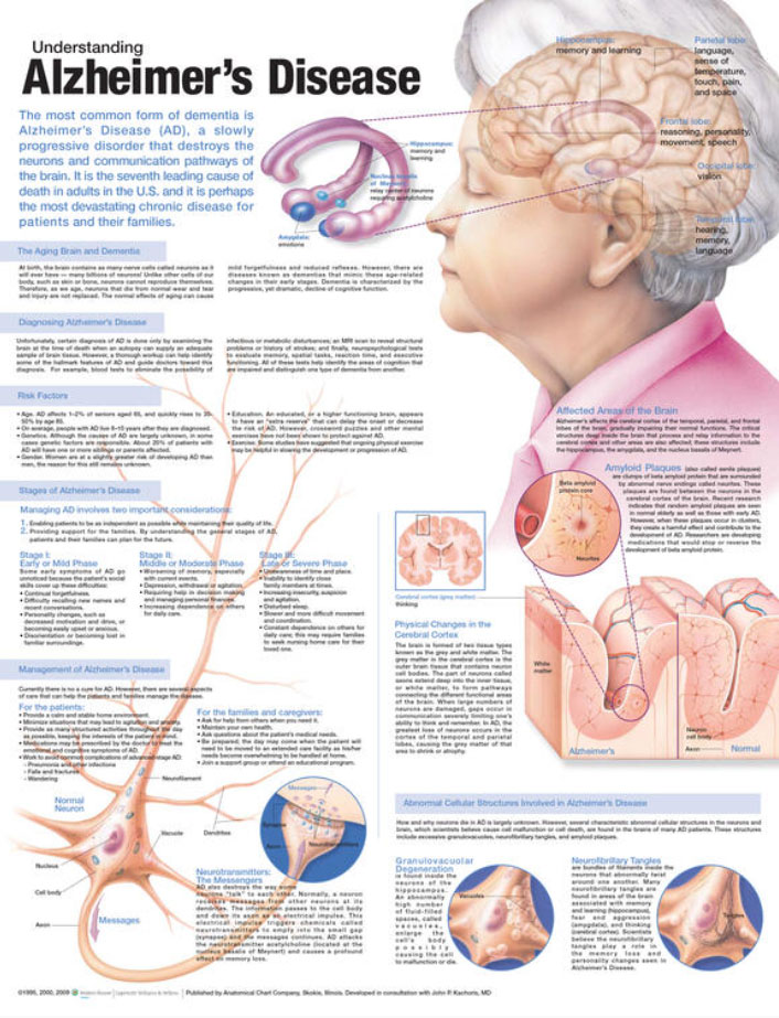 Understanding Alzheimer’s Chart