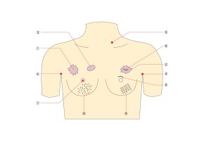 Breast Cancer Training Model