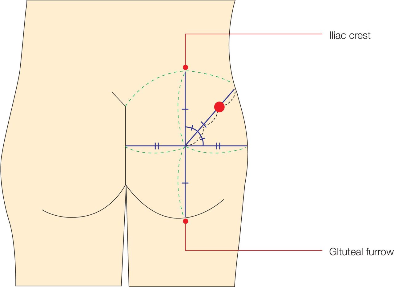 Dorsogluteal Intramuscular Injection Model