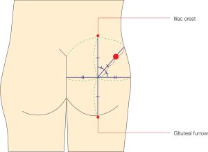 Dorsogluteal Intramuscular Injection Model