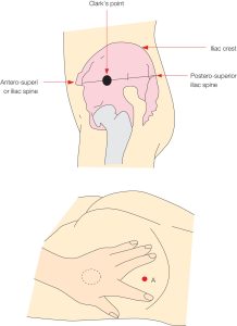 Ventrogluteal Intramuscular Injection Model